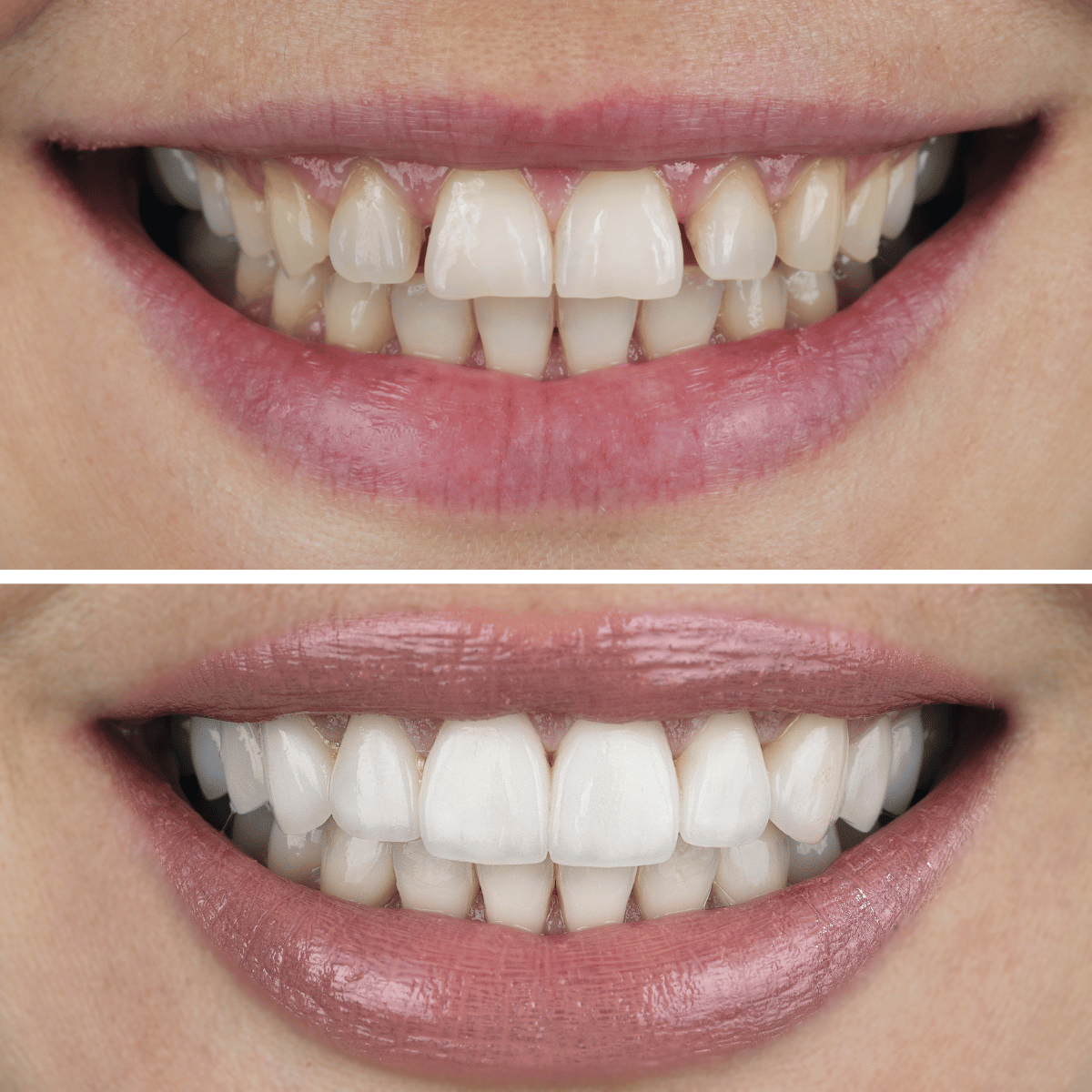 Non-prep veneers kan settes ret på tennene med minimal fjerning av emalje