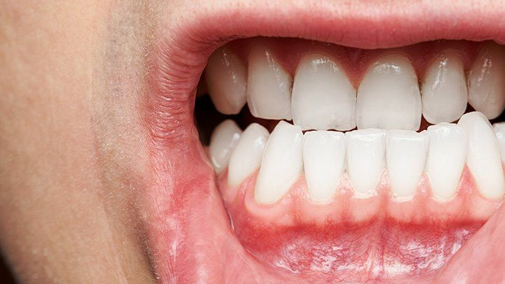 Gingivitt: Alt du trenger å vite
