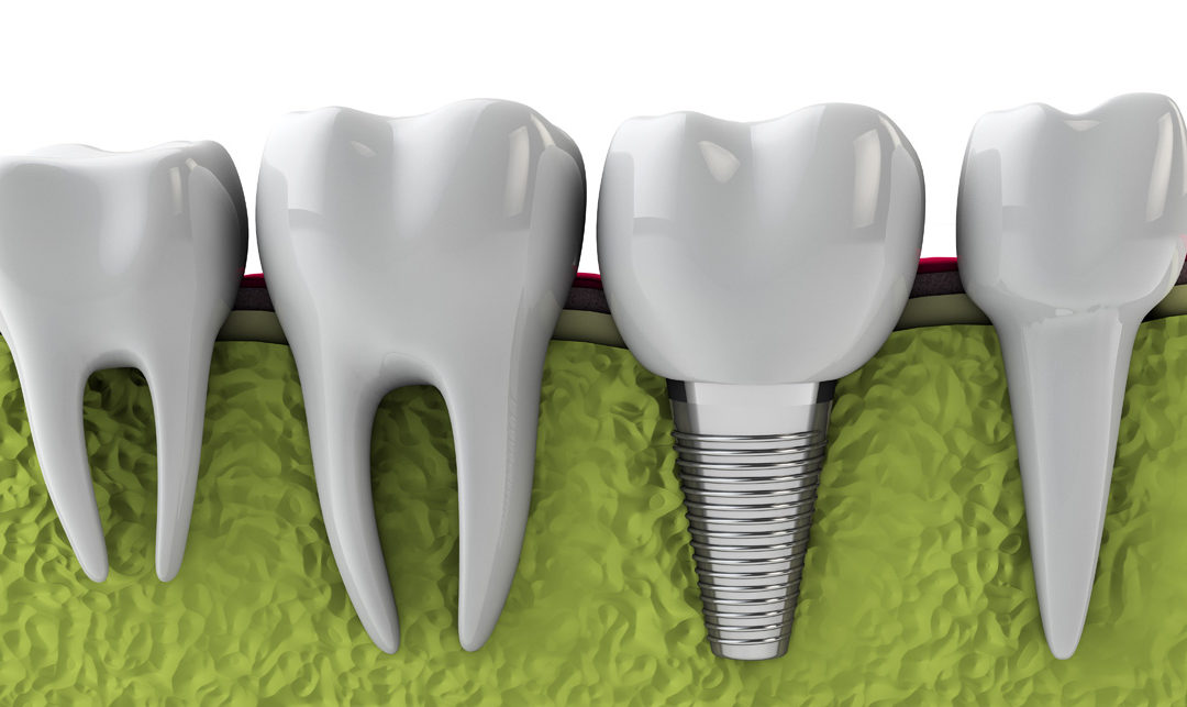 Ekesmpel på en implantat