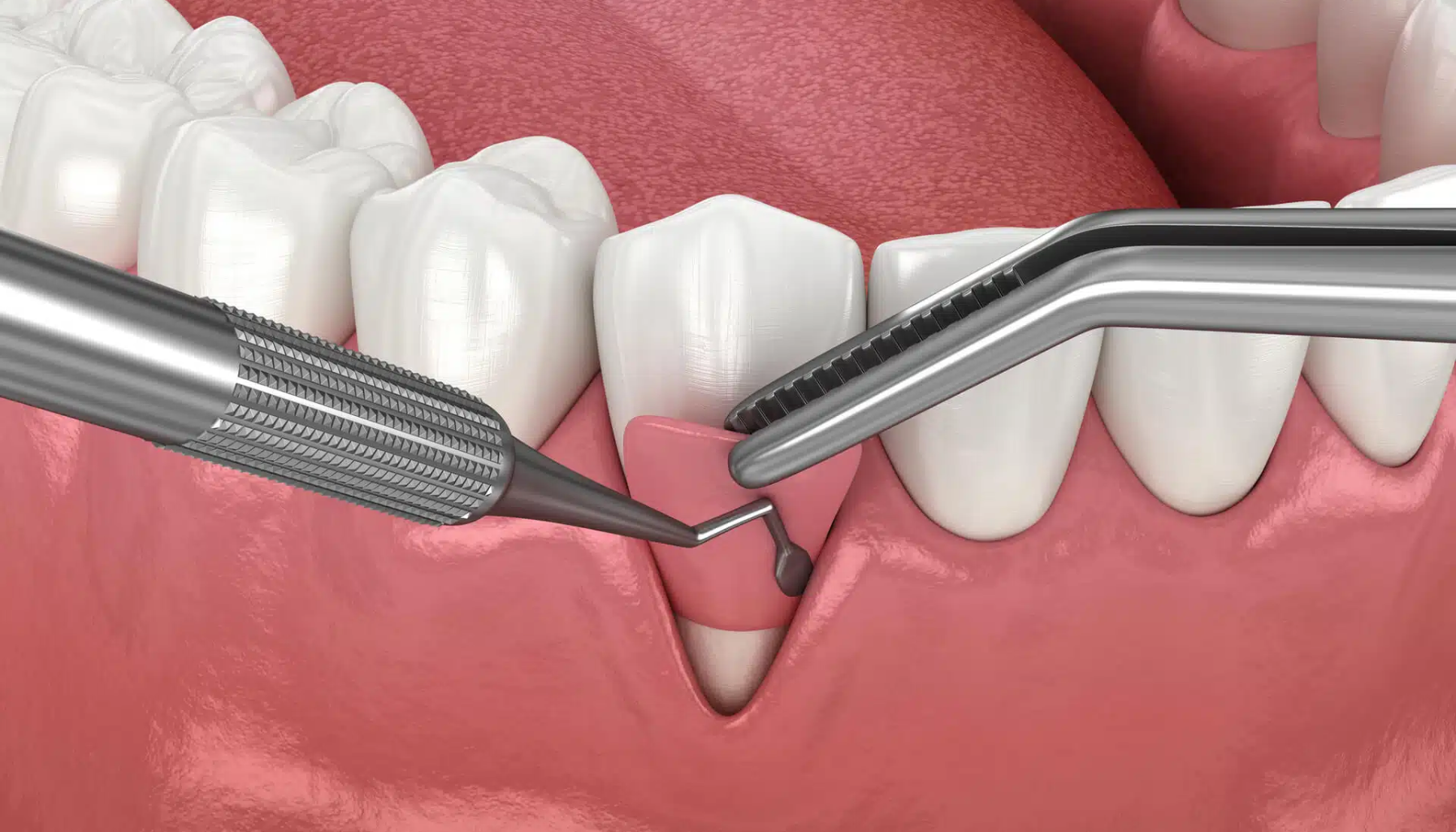 Få tilbake smilet ditt med tannkjøtttransplantasjon: Slik fungerer det Få tilbake smilet ditt med tannkjøtttransplantasjon: Slik fungerer det