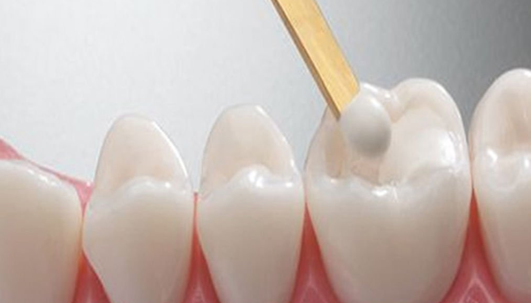 En illustrasjon av en tannbehandling der en tannfylling påføres en jeksel ved hjelp av et tannlegeverktøy for å reparere et hull i tannen.