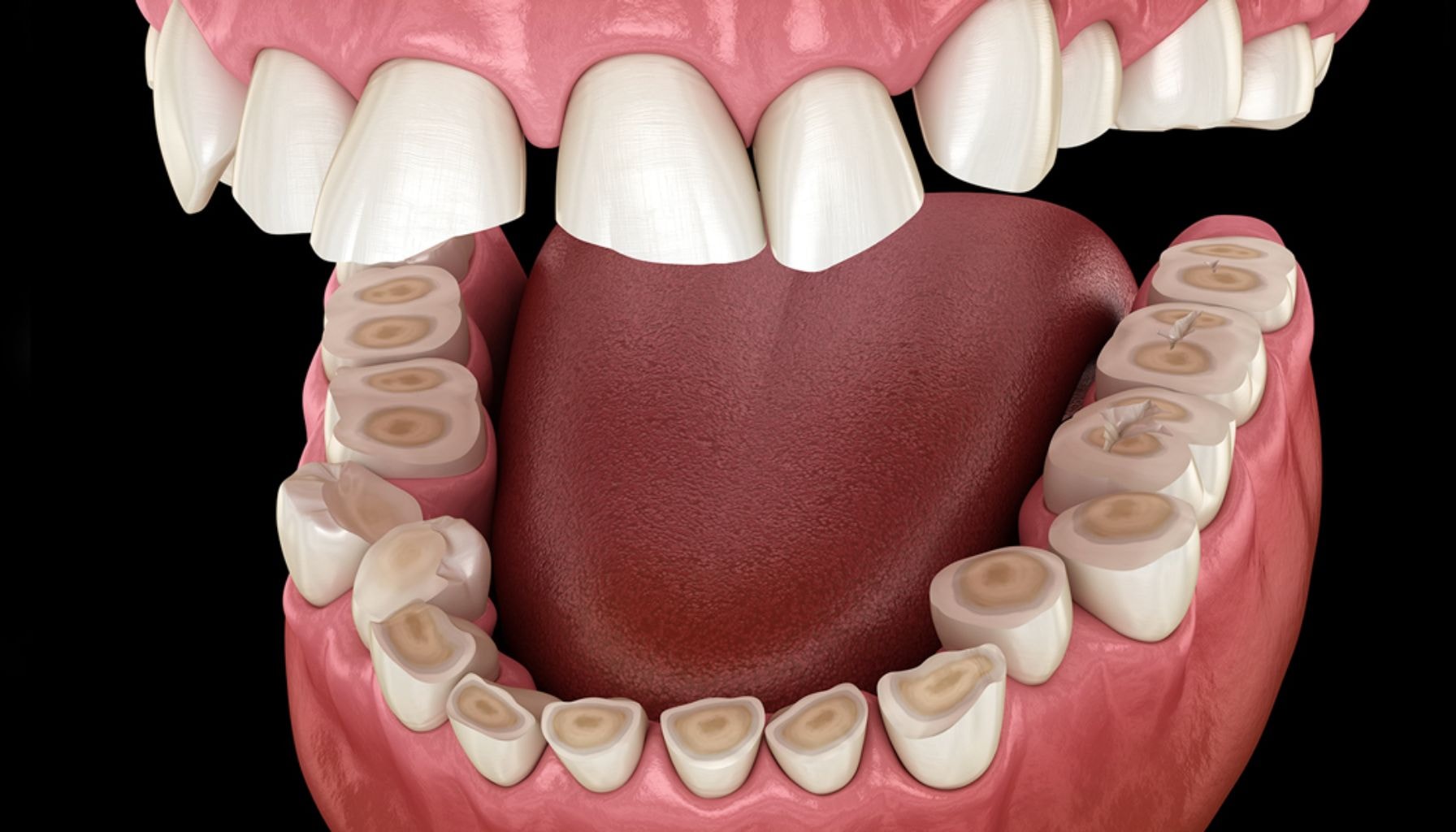 Slitasje på tennene: 3D-illustrasjon av alvorlig tannslitasje med eksponert dentin på de nedre jekslene, sett fra innsiden.