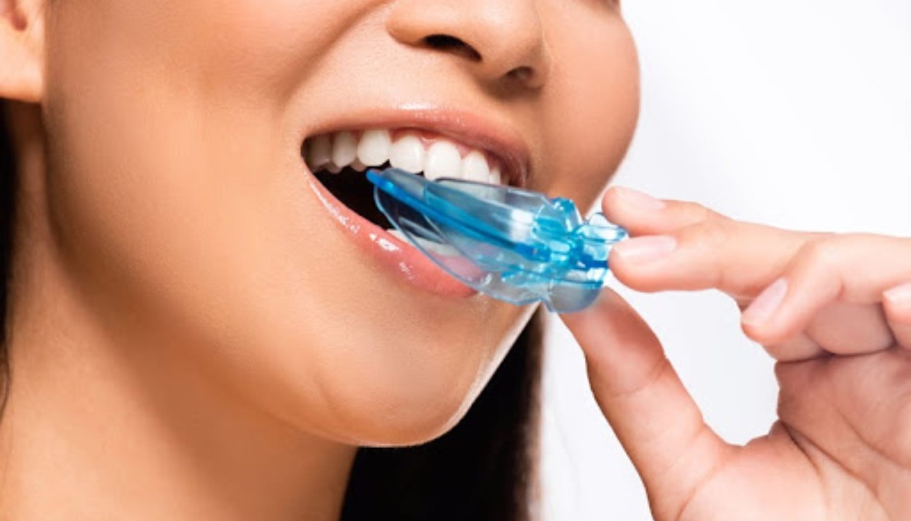 Kvinne bruker en blå tannskinne for beskyttelse mot tanngnissing eller søvnapné, og setter den forsiktig inn i munnen. skjære tenner tanngnissing hos tennene dine slapper mer