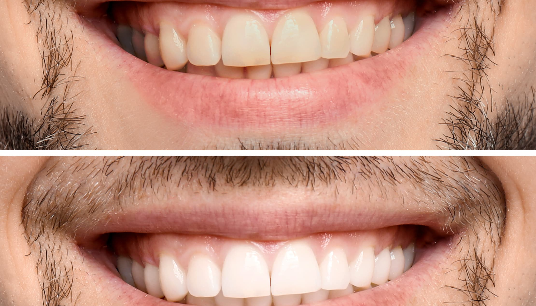 Før-og-etter-bilde av en manns smil som viser resultatet av tannbleking, med tydelig lysere og hvitere tenner etter behandling.