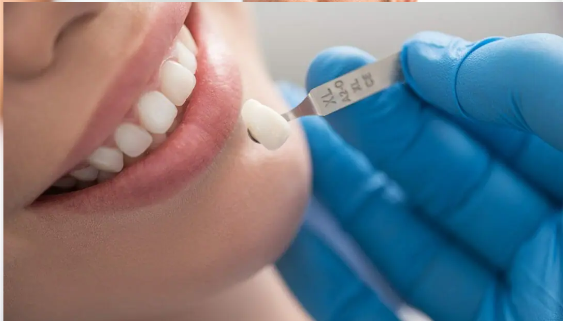 Tannlege med blå hansker tilpasser en tannkrone eller fasett for å matche pasientens naturlige tannfarge.