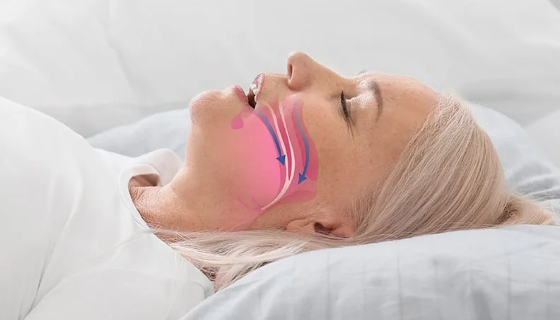 Apné og Tannlege: Når Søvnvansker Starter i Munnen Apné og Tannlege: Når Søvnvansker Starter i Munnen