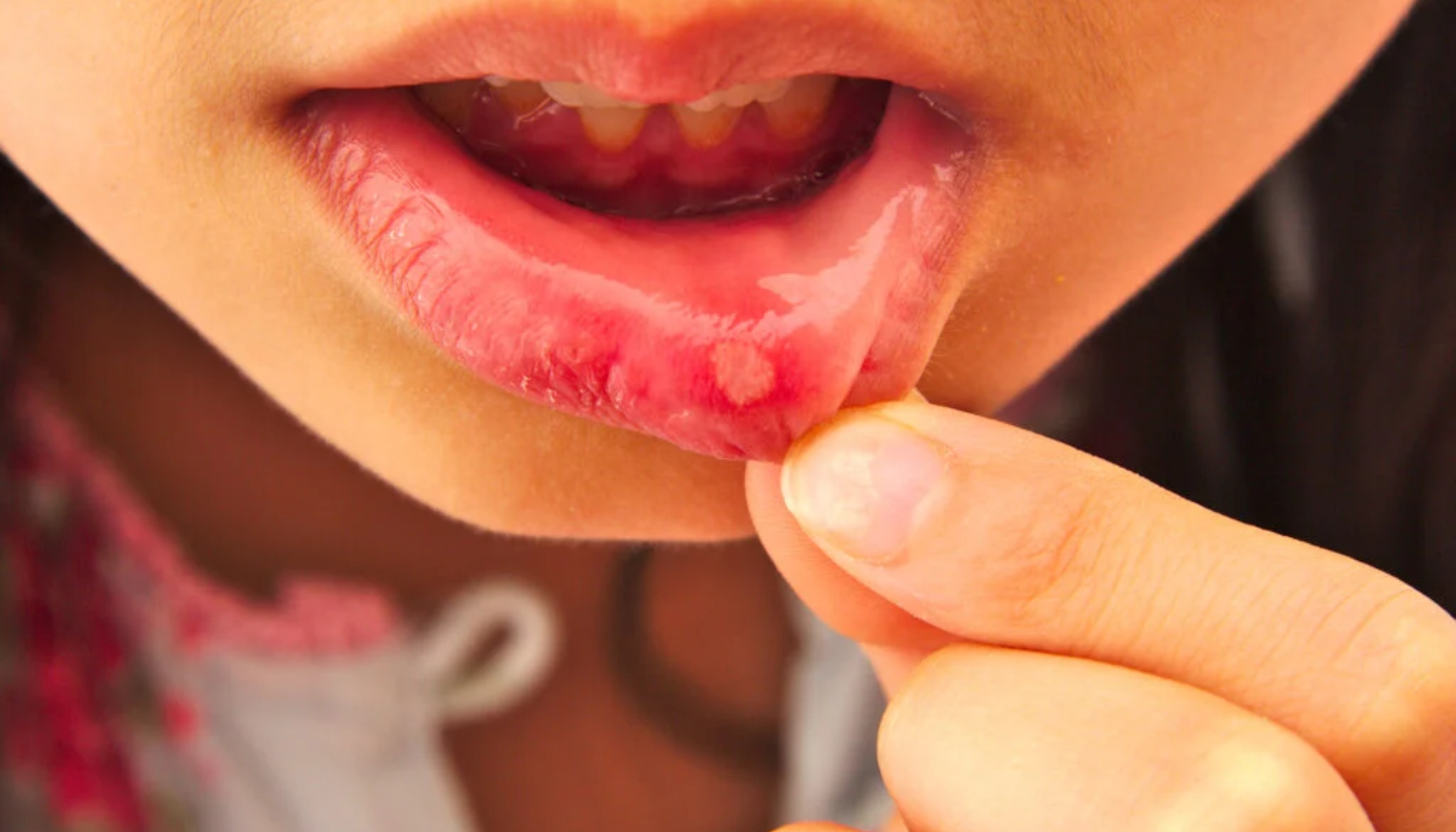 Nærbilde av barn som viser munnsår på innsiden av underleppen ved å trekke leppen ned med fingrene.