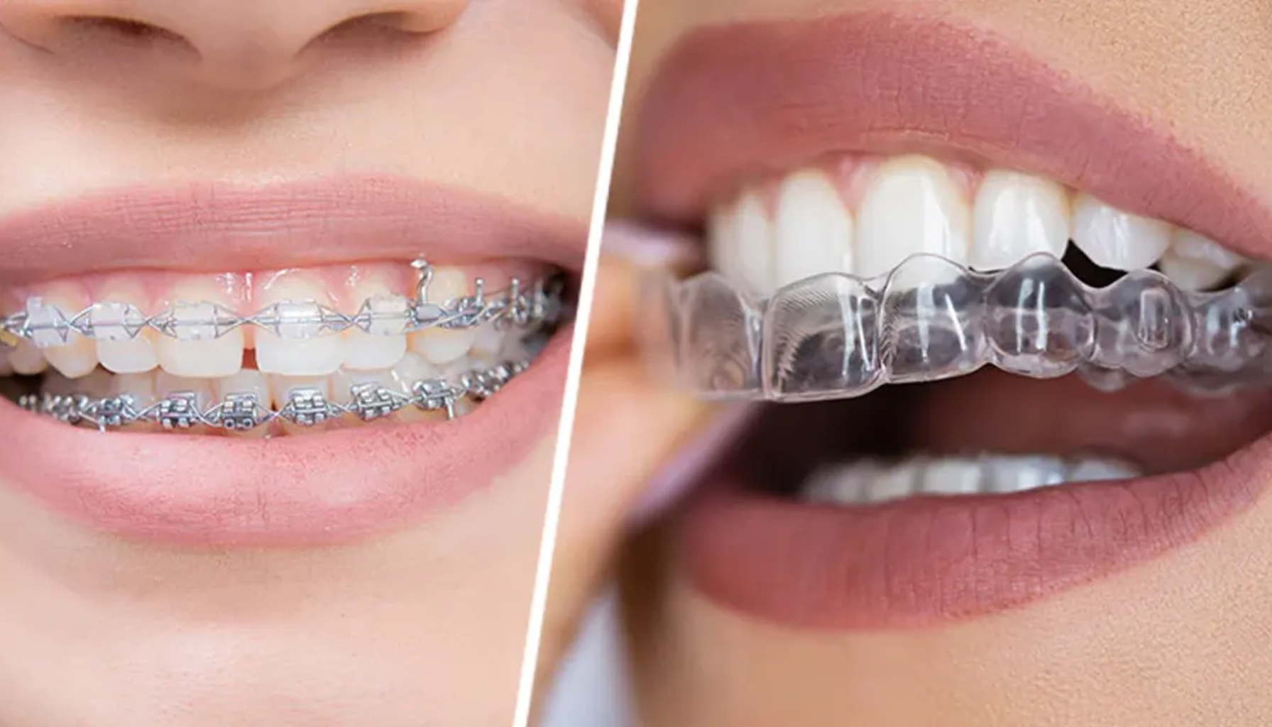 Sammenligning av tannregulering: tradisjonell metallregulering til venstre og gjennomsiktig tannskinne til høyre.
