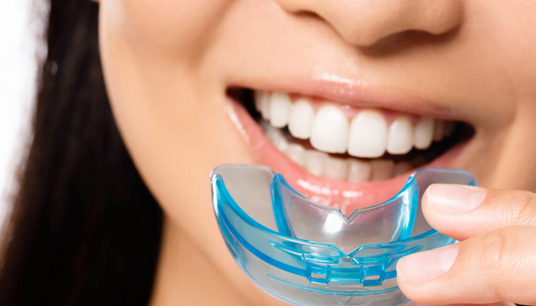 En kvinne med hvite tenner holder en blå tannreguleringsskinne nær munnen, klar til å sette den inn for tannjustering.