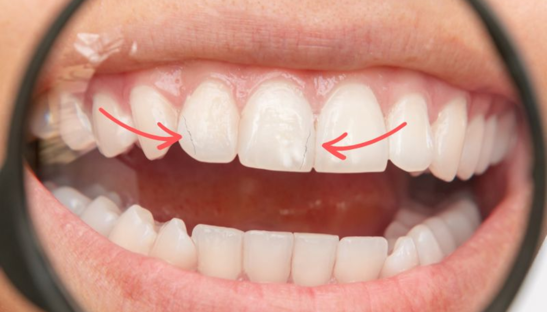 Nærbilde av tenner med sprekker i emaljen markert med røde piler, sett gjennom et forstørrelsesglass. behandling av knekt tann tannen er knekt time på dagen skarpe kanter tannen må dersom skaden større skader tennene knekker time gjør bit pris akutt grunn kommer del hardt mye